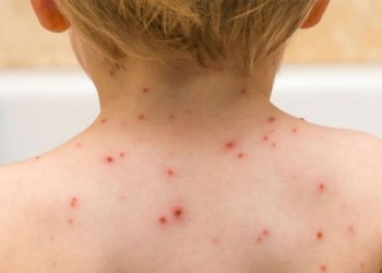 Marataízes registra 105 casos confirmados de varicela desde 1º de julho