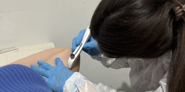 Pinheiros realiza primeira inserção de Implanon pelo SUS